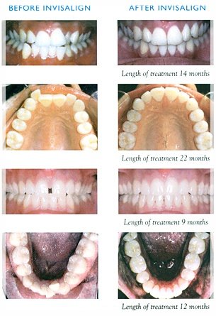 b_a_Invisalign.jpg