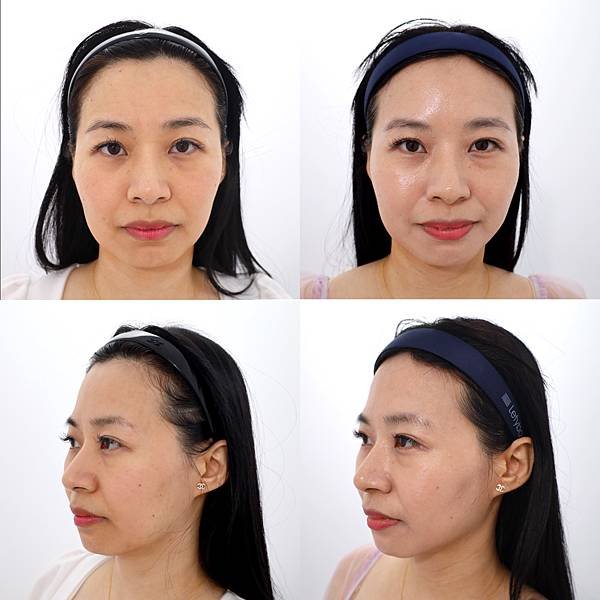 台北醫美推薦佳思優整形醫美診所，我要的輪廓線條Z音波都辦得到