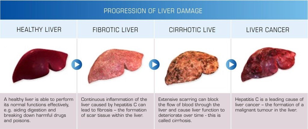the-progression-of-liver-disease.jpg