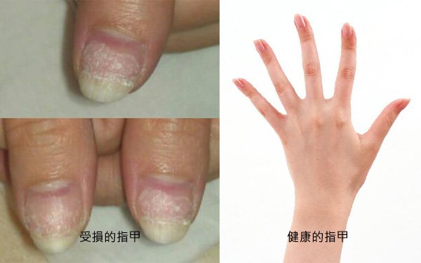 before&amp;after_nail