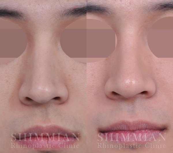 歪斜鼻梁矯正，鹰钩鼻手術 1