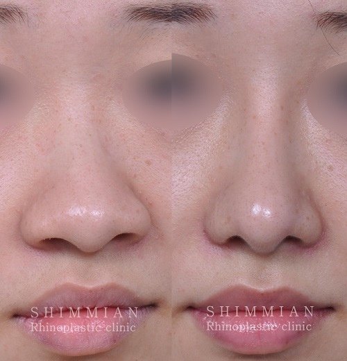 歪鼻手术1.jpg