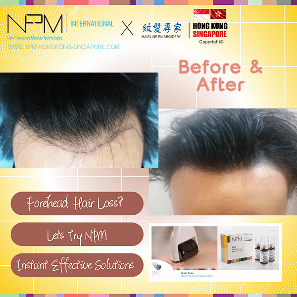 【NPM 纹发专家】SG -- Hairloss makes