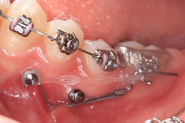 如何有效率的upright molar? (How to u