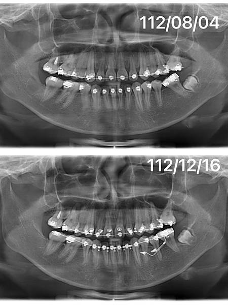 如何有效率的upright molar? (How to u