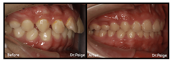 深咬篇-蔡佩晏醫師的矯正故事