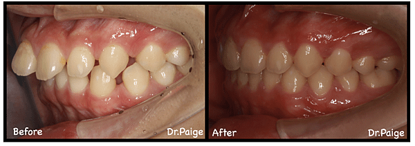 深咬篇-蔡佩晏醫師的矯正故事