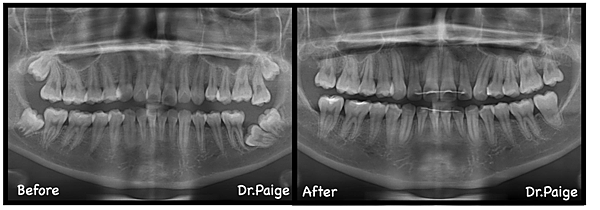 臼齒阻生篇 (臼齒長不出來)-蔡佩晏醫師的矯正故事