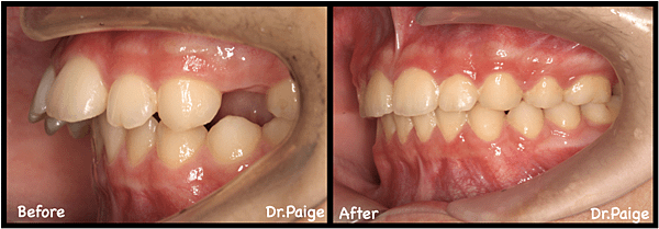 已經拔牙篇-蔡佩晏醫師的矯正故事-蔡佩晏醫師的矯正故事