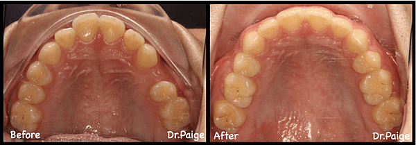 已經拔牙篇-蔡佩晏醫師的矯正故事-蔡佩晏醫師的矯正故事