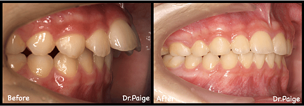 已經拔牙篇-蔡佩晏醫師的矯正故事-蔡佩晏醫師的矯正故事