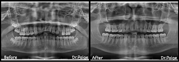 已經拔牙篇-蔡佩晏醫師的矯正故事-蔡佩晏醫師的矯正故事