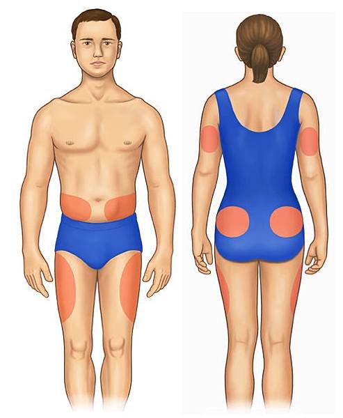 Insulin_injection_sites_PI