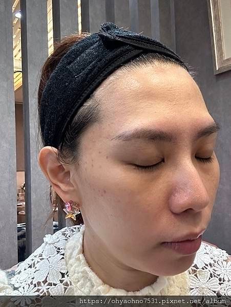 [台北東區皮秒雷射推薦診所] 台北蜂巢皮秒就到延吉美皮膚專科
