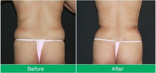 liposuction-abdomen-2.jpg