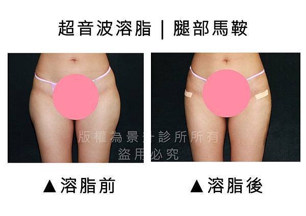 腿部馬鞍超音波1.jpg