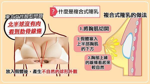 什麼是複合式隆乳.jpg