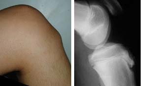 osgood-schlatter