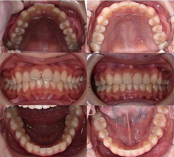 [案例分享]不拔牙合併骨釘 全齒列後移 改善前牙微斜
