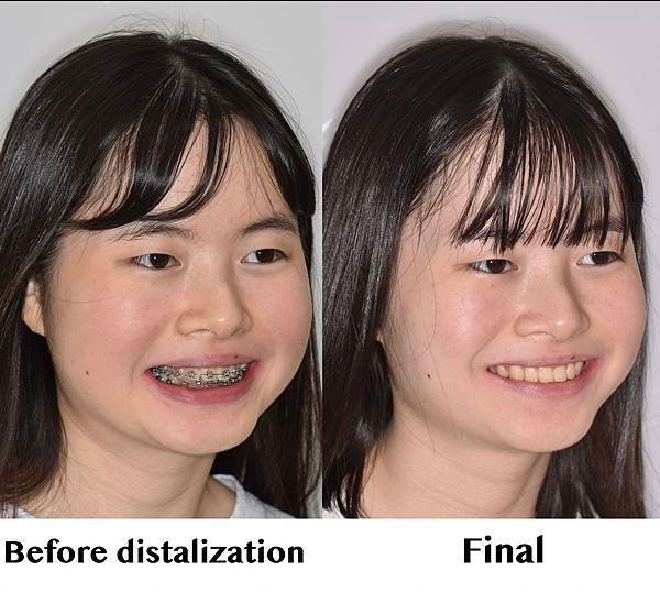 [案例分享]不拔牙合併骨釘 全齒列後移 改善前牙微斜