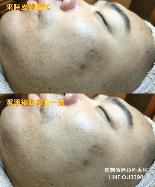 右臉頰前後編輯.jpg