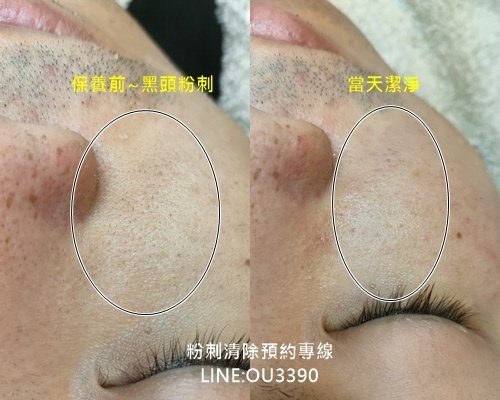 右臉頰前後編輯.jpg