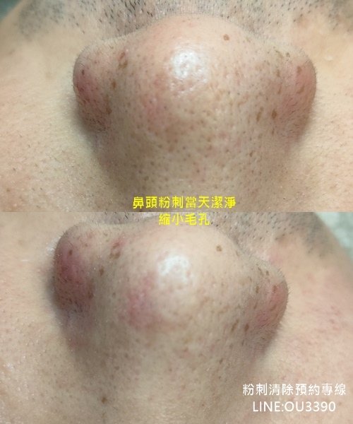 鼻子前後編輯.jpg