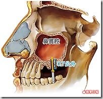 植牙鑽穿鼻竇