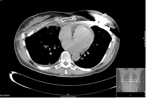 chest-CT