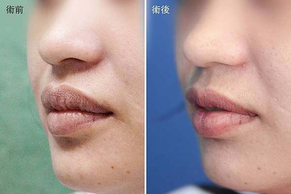 Lip reduction_compare.jpg