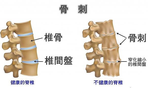 骨刺.jpg