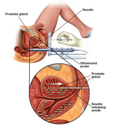 prostate-cancer-2.png