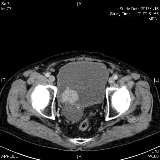 urinary bladder cancer2.jpg