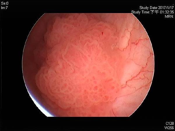 urinary bladder cancer4.jpg