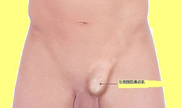 Inguinal-Hernia.jpg