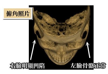 韓式微創削骨照片