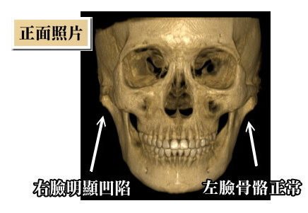 韓式微創削骨後遺症風險