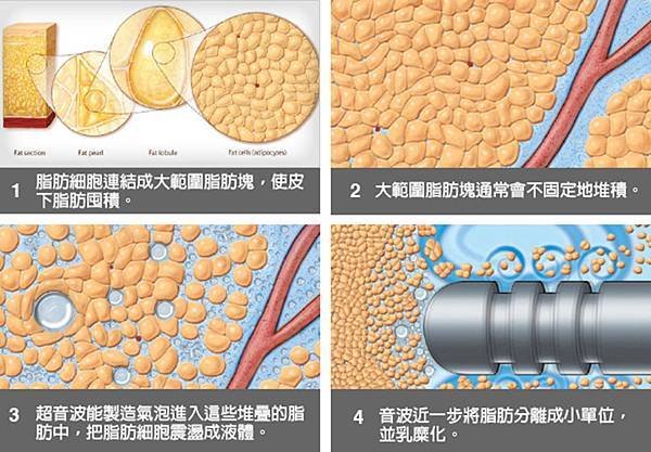 02超音波溶脂能有效瘦臉嗎？.jpg