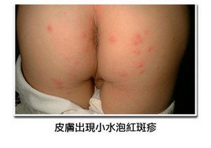 腸病毒3.jpg