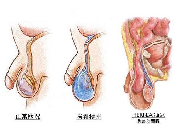 疝氣陰囊積水.jpg