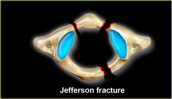 Jefferson Fracture