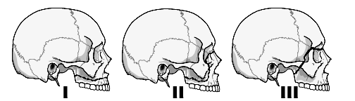 LeFort Fracture2