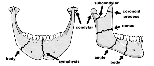 mandibular fracture