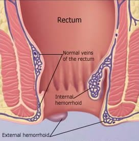 Hemorrhoid