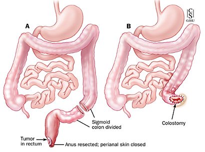 Abdominoperineal Resection