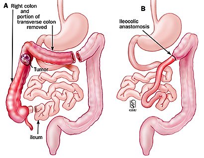 Extended Right Colectomy