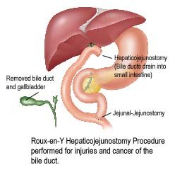 Roux-en-Y hepaticojejunostomy