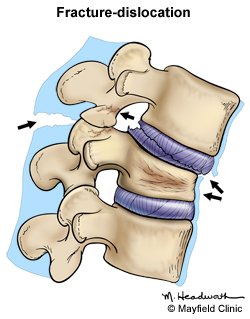 Fracture-Dislocation