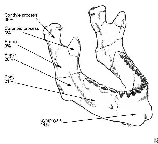 mandibular fracture2