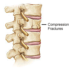 Compression fracture